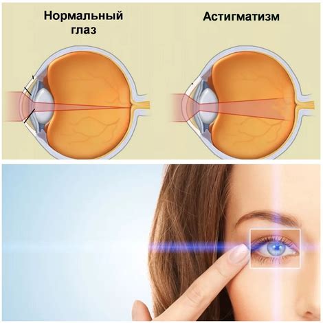 Астигматические контактные линзы: отзывы, цены, можно ли носить обычные ...