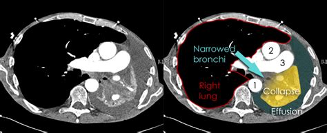 Fluid Around Lung Ct Scan 
