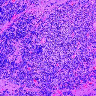 Histopathological Finding Of Endobronchial Ultrasound Guided