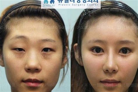 Глаз После Операции Фото – Telegraph