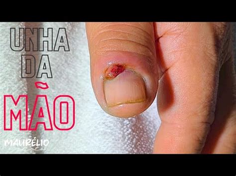 O DEDO VIROU UM GRANULOMA COMO TRATAR APÓS UM CORTE DE SERROTE