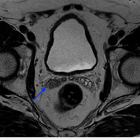 T2 Weighted Mri Showing Low Signal Intensity In The Right Seminal