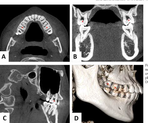 Figure From Morphology Changes Of Maxillary Molar Distalization By