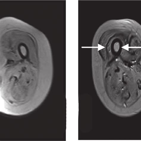 A Mri Scan Of Md Patient S Vastus Medialis And Lateralis Muscles Download Scientific Diagram