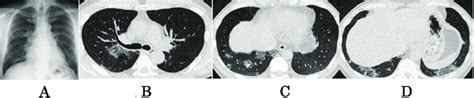 Chest X Ray And Chest Plain Computed Tomography A Chest Radiograph On