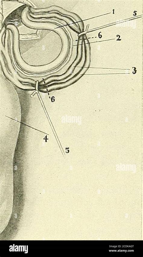 Ligation Male