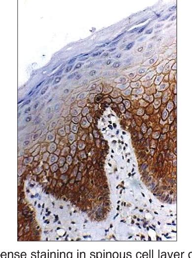 Figure 1 From Immunohistochemical Analysis Of Syndecan 1 In Leukoplakia