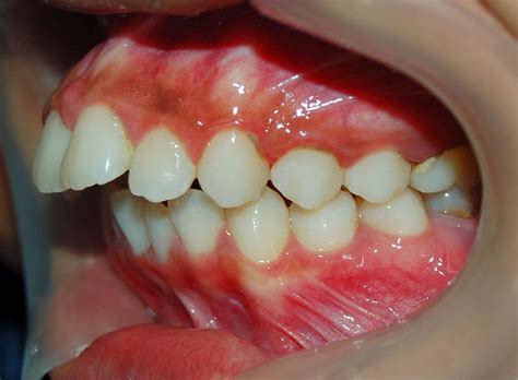 Tipos De Mordida Protrusi N Cl Nica Dental Casaus