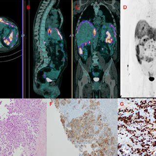 18 F FDG PET CT Of A 61 Year Old Man A Transaxial Fused PET CT