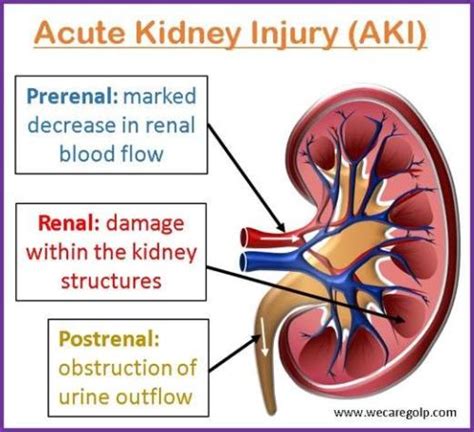 Acute Kidney Injury (AKI) - We Care