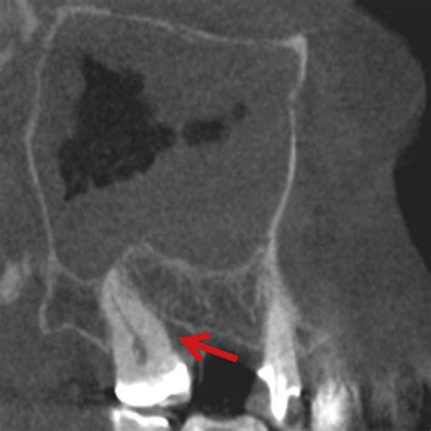 Periodontal Bone Loss Pbl Associated With Chronic Sinusitis Red