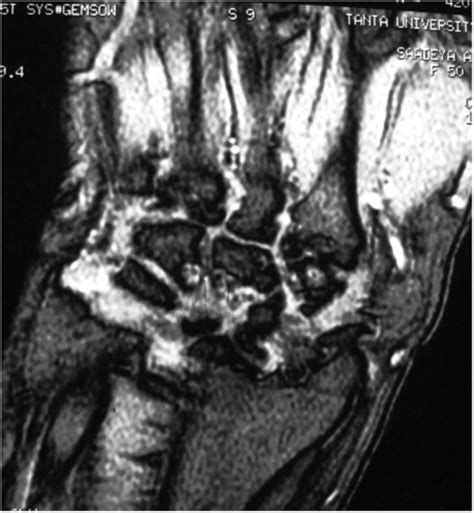 Mri Of The Hand And Wrist Revealed Bone Marrow Edema And Erosion Of The Download Scientific