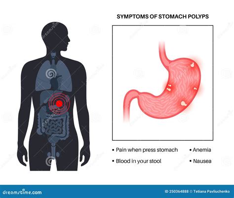 Stomach Polyp Disease Stock Vector Illustration Of Digestive 250364888