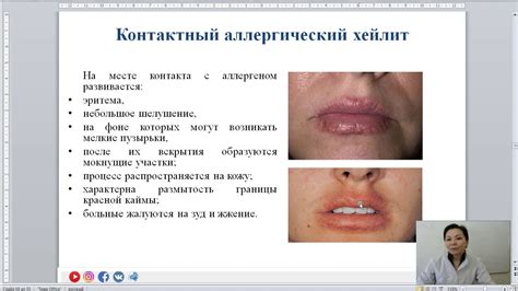 Хейлиты - YouTube