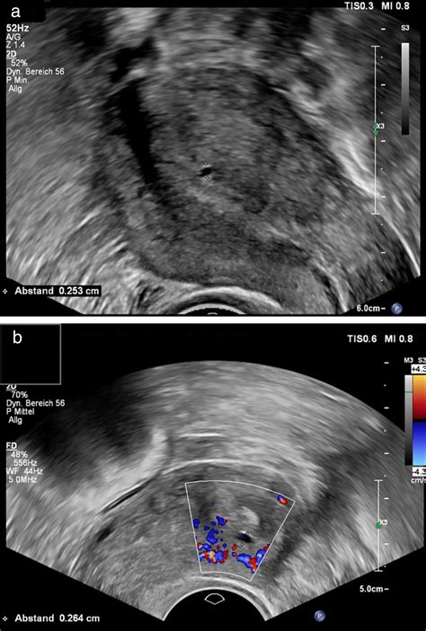 Accuracy Of Ultrasound Signs On Two‐dimensional Transvaginal Ultrasound