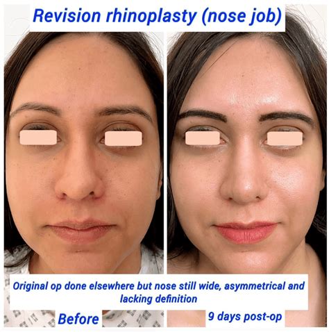 Does Your Nose Keep Growing After Rhinoplasty Surgery Harley Clinic