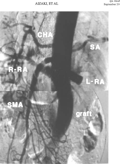 Figure 4 From Reconstruction Of Heavily Calcified Aorta And Its