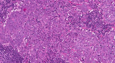 Acinic Cell Carcinoma MyPathologyReport Ca