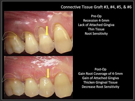 Gum Grafting Huntington Beach Cosmetic Periodontics Dr Braga