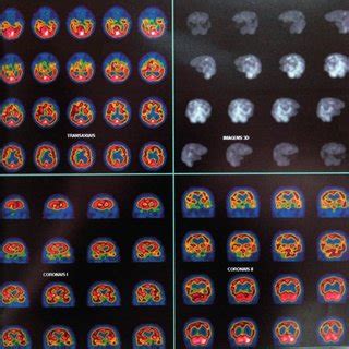 Single Photon Emission Computed Tomography Spect Image Showing