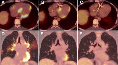 Sequential Fdg Pet In The Management Of Multiorgan Sarcoidosis Thorax