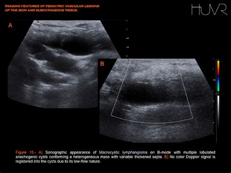 Figure 7 From Imaging Features Of Pediatric Vascular Malformations Of The Skin And Subcutaneous