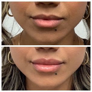 Lip Filler Specialists Near Me See Our Lip Before Afters