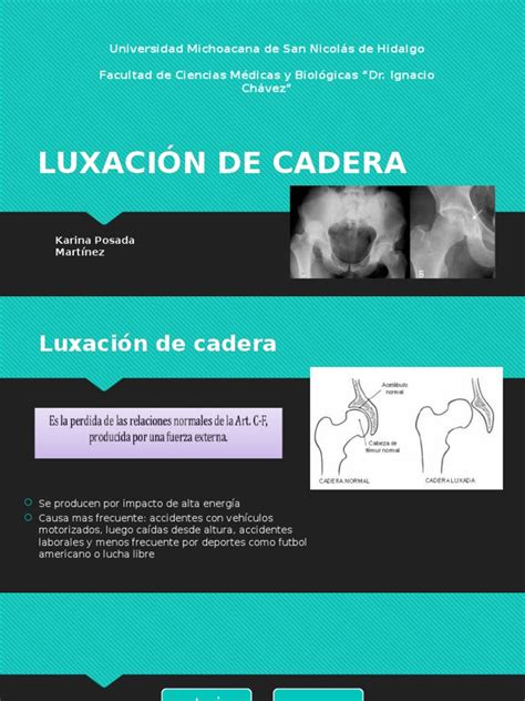 Pdf LuxaciÓn De Cadera 1ppsx Dokumentips