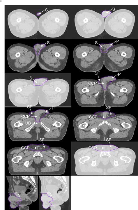 Figure From Proposed Genitalia Contouring Guidelines In Anal Cancer Intensity Modulated