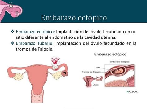 Embarazo Ectopico