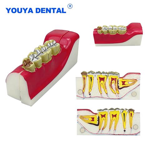 Dental Decomposition Model Anatomy Study Model Molar Cross Section Of