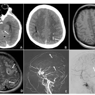 FIGURE E Radiographic features of CVT in the case of NN who presented ...