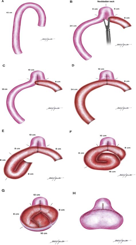 Robotic Intracorporeal Padua Ileal Bladder Surgical Technique