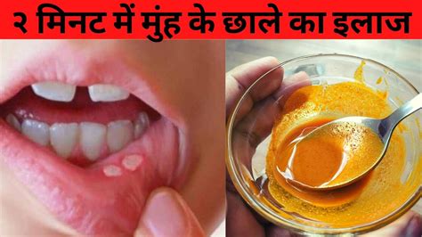 2 मिनट में मुंह के छाले और जीभ के छाले ठीक करने का घरेलू उपाय How To