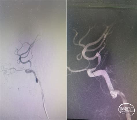 【载药时代 球扩天下】nova Des®颅内药物洗脱支架在颈动脉颅内段重度狭窄的应用一例！ 脑医汇 神外资讯 神介资讯