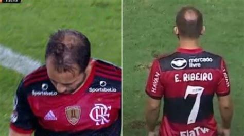 Ex Calvo Everton Ribeiro Do Flamengo Admite Ter Feito Transplante