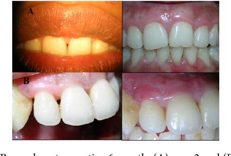 Figure 1 From Surgical Reconstruction Of Interdental Papilla Using