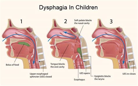 Dysphagia Symptoms