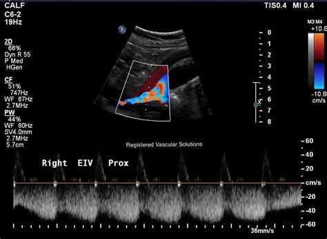 External Iliac Vein Ultrasound