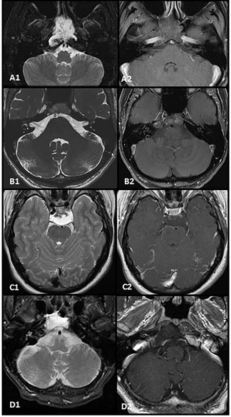 MRI Enhancement Patterns In 28 Cases Of Clival Chordomas Journal Of