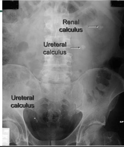 Urology Flashcards Quizlet