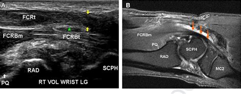 Flexor Carpi Radialis Tenosynovitis