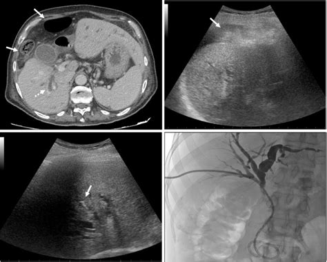 Safety And Effectiveness Of Ultrasound Guided Percutaneous Transhepatic