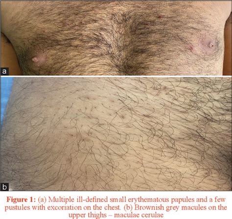 Figure From Pediculosis Pubis Presenting As Pediculosis Capitis