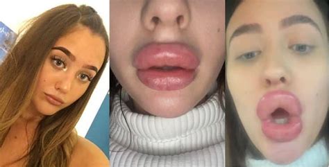 Lady claims that a £100 filler treatment left her lips so swollen