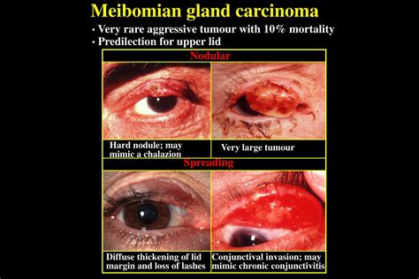 Ppt Malignant Eyelid Tumours Powerpoint Presentation Free Download Id6689798