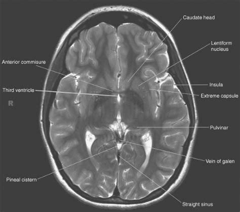 Axial Brain Anatomy