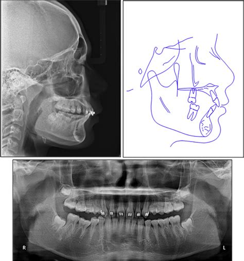 Figure From Severe Class Ii Division Malocclusion In An Adolescent