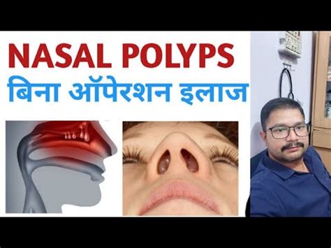 Nasal Polyp Homeopathic Treatment YouTube