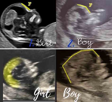 How to 'predict' baby's gender from an early ultrasound